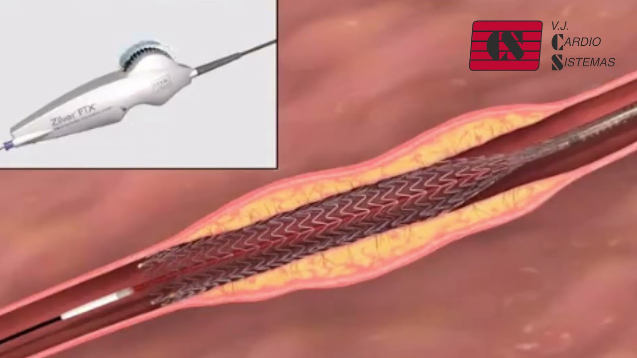 ZILVER PTX - COOK MEDICAL/ VJ CARDIOSISTEMAS