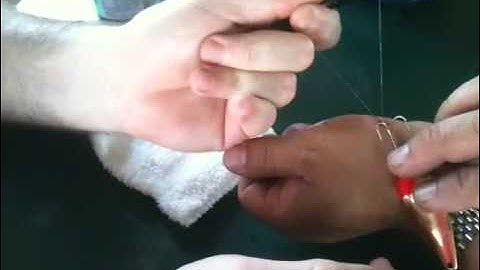Fishhook string removal technique