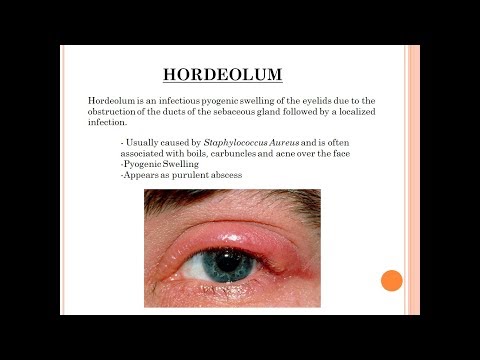 Video: Udvendigt øjenlåg Stye (Hordeolum Externum)