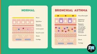 Allergic Asthma Lecture 4 Allergic Asthma Lecture 4