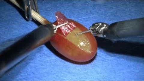 Precision of Robotic-Assisted Surgery