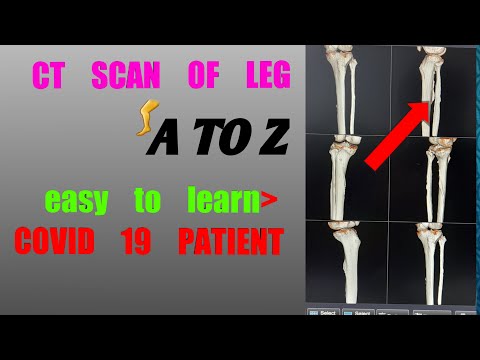 CT SCAN OF LEG Technique( A TO Z )