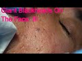 Giant Blackheads  - Part III -