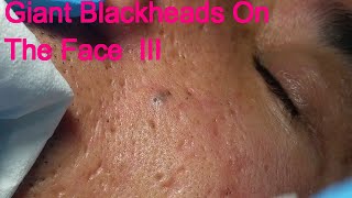 Giant Blackheads  - Part III -