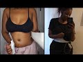 Vlog: 1 Week Post-Op Smooth Tuck & Fat transfer |Belly shot! 14lb Weight Gain! Standing Straight?