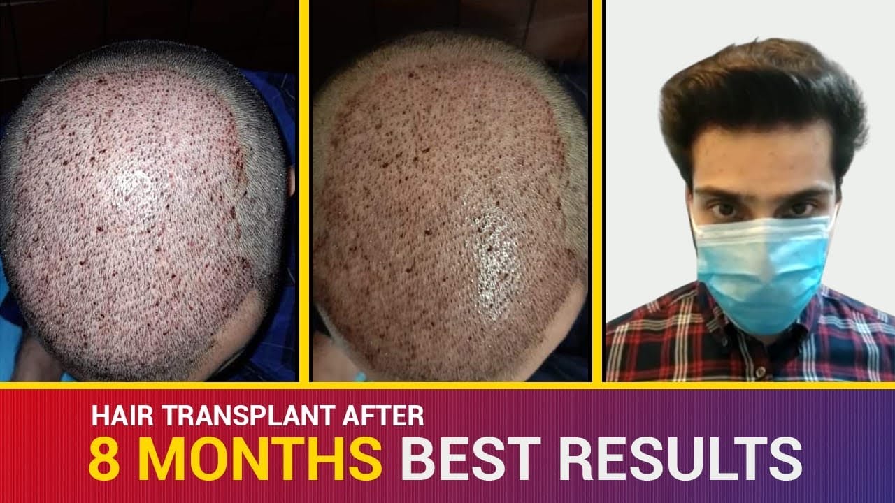 Live unbelievable results of client from Rawalpindi Hair Transplant