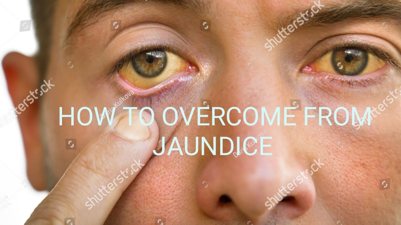 HOW TO OVERCOME FROM JAUNDICE |HEALTH TIPS | COOKING TIPS | HOME ...