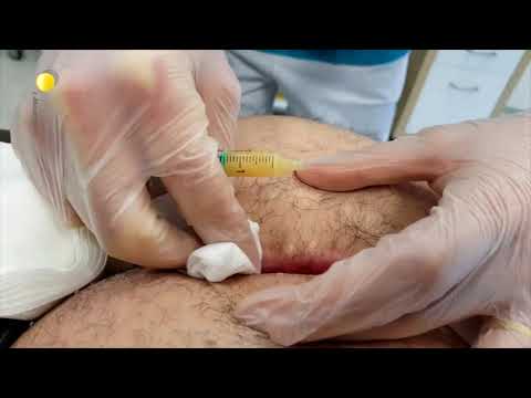 Video: Absces Hýždí Po Injekci - Příčiny, Příznaky A Léčba