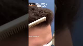 Hairline restoration #hairline #hairlinetransplant #fuehairtransplant #hairtransplant #haircare