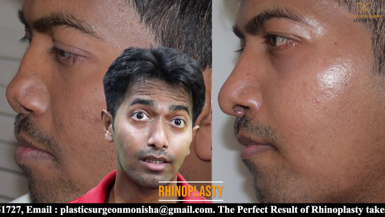 Lengthening of short nose rhinoplasty Nose Job Best Result After 4