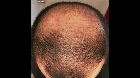 6 months using minoxidil - Rogaine 5% Before & After results