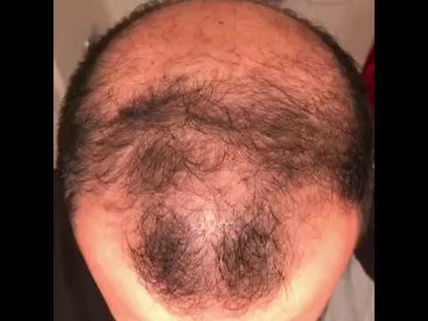 6-months-using-minoxidil---rogaine-5%-before-&-after-results