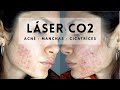 ACNÉ LASER CO2 Manchas y Cicatrices | Niki Mayo