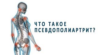 Что такое псевдополиартрит и как его нужно лечить? Что такое псевдополиартрит и как его нужно лечить?
