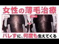 【女性の薄毛を治す方法】抜けても何度も生える最新治療を紹介【湘南美容クリニック医師が解説】