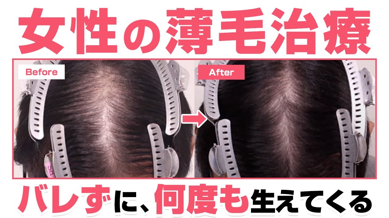髪 が 生える 方法 女性