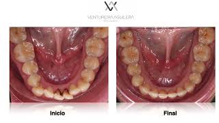 Invisalign Ortodoncia Apiñamiento Clase II: Distalamiento + Expansión + Corrección de Angulación