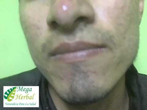 cura de acne rosacea remedio casero  medicina natural uriel tapia 