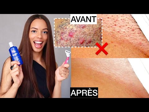 S.O.S: Épilation du Maillot: ANTI Boutons, Poils Incarnés & Peau Foncée | Conseils/Produits Miracles