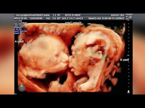 Unsuspecting Mom-To-Be Shocked After Ultrasound