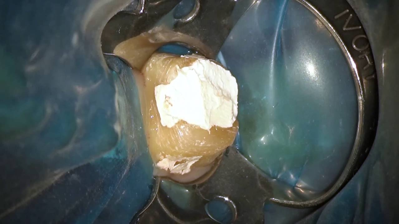 Live Root Canal Demonstration on tooth #18 by Dr. Brett E. Gilbert ...