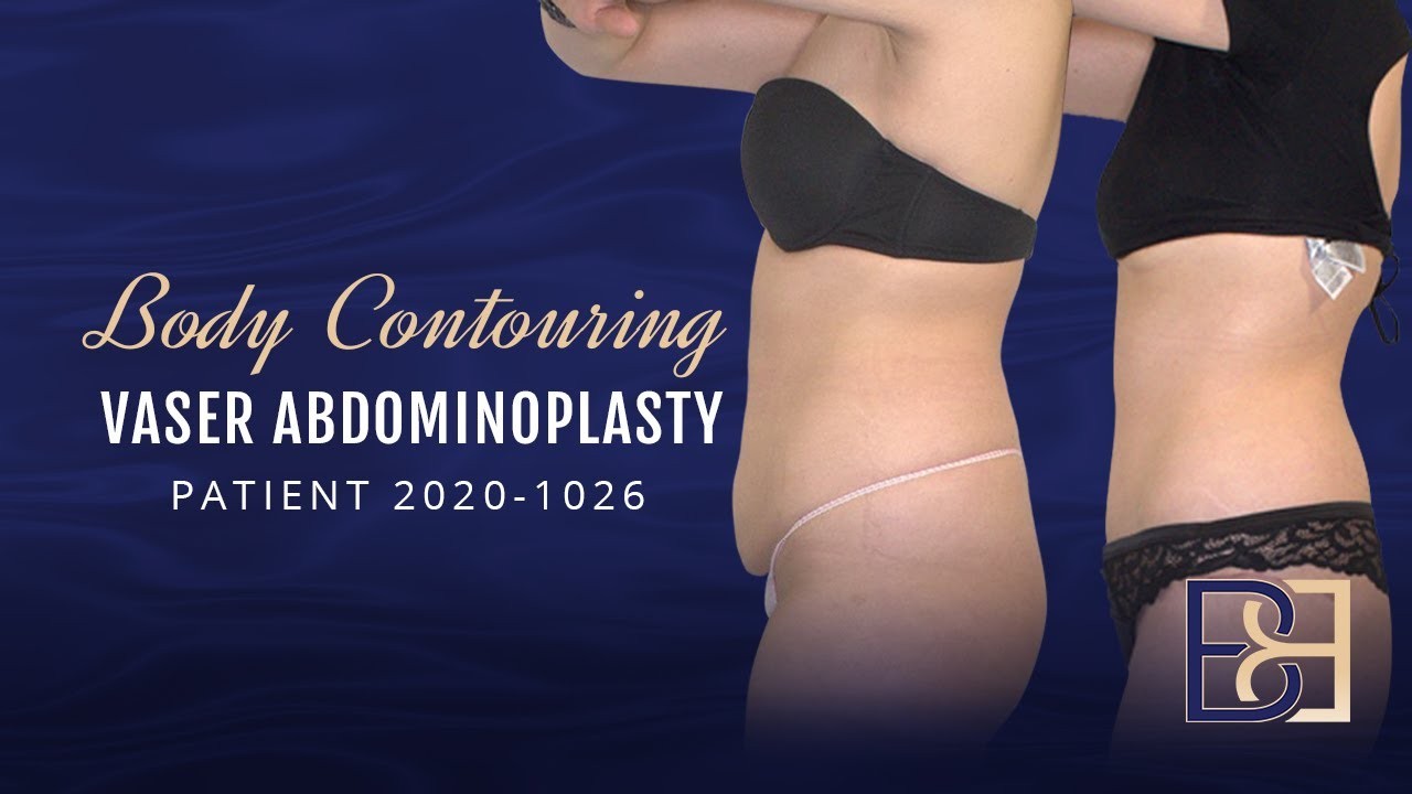 Operation Guide: Lipo-abdominoplasty Surgery