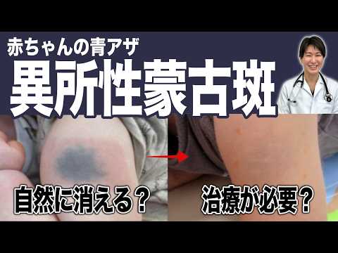 【異所性蒙古斑】赤ちゃんの青あざ治療は可哀想？今すぐ相談することが「一番きれいに消える」理由