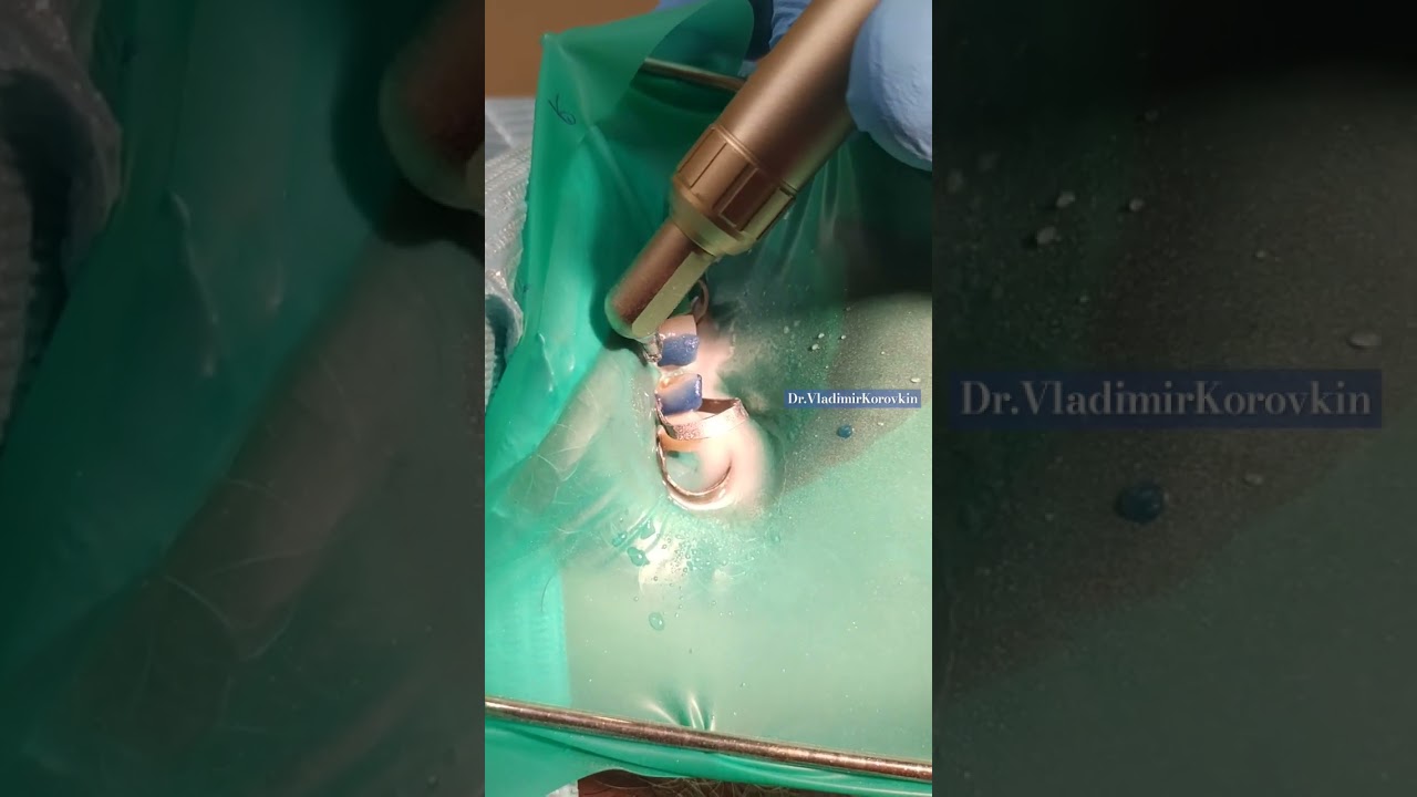 Abrasive treatment of the surface of the 12th tooth with aluminum oxide 30 microns.