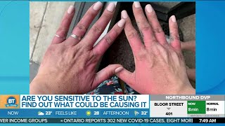 Are you sensitive to the sun? Find out what could be causing it