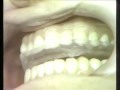 Delivering and Adjusting the Occlusal Bite Plane Splint