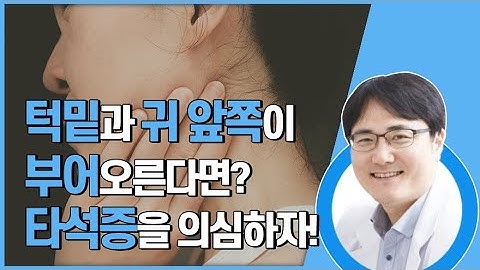 턱밑과 귀 앞쪽에 부어오른다?! 타석증을 의심하자!