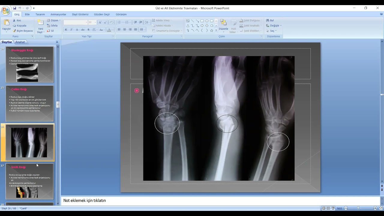Üst ve Alt Extremite Travmaları