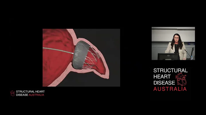 Procedural TOE Guidance for Left Atrial Appendage ...