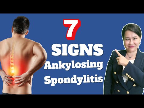 Video: Je, spondylitis huisha?