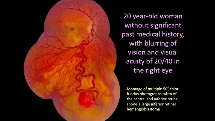 Learn About Ocular von Hippel-Lindau Disease With ...
