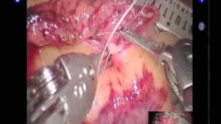 TeamCirisano Teaching Series: Robotic da Vinci Laparoscopy 3D High Definition Visual Advances