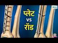 Fracture होने पर Plaster की जगह Plate या Rod कब लगाते हैं, कौन बेहतर? | Sehat Ep 1371