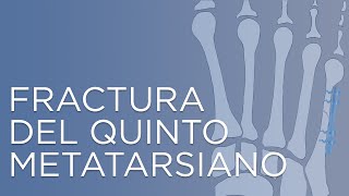 Fractura del quinto metatarsiano | IQTRA