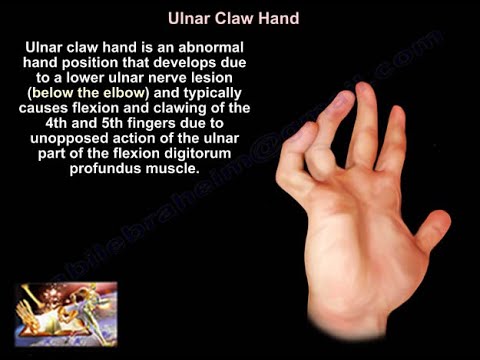 Claw Hand and Ulnar Claw Hand - Everything You Need To Know - Dr