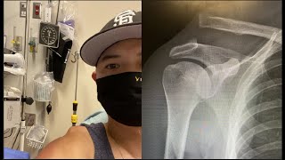 My recovery from AC joint separation grade V