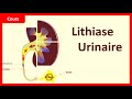 Lithiase urinaire   questce que cest    cours  uronephrologie