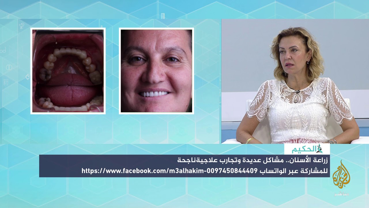 دليلك الشامل لزراعة الأسنان مع د.تولاي أكقول
