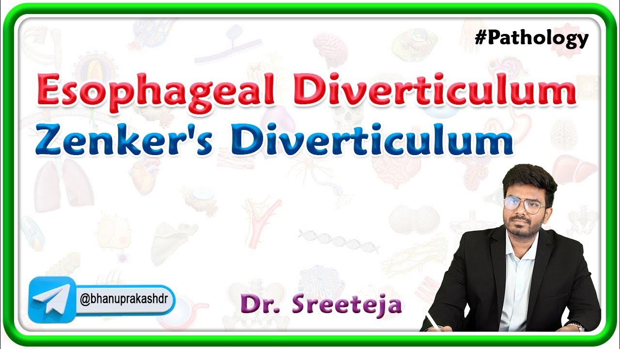 2-esophageal-diverticulum-zenker-s-diverticulum-usmle-step-1