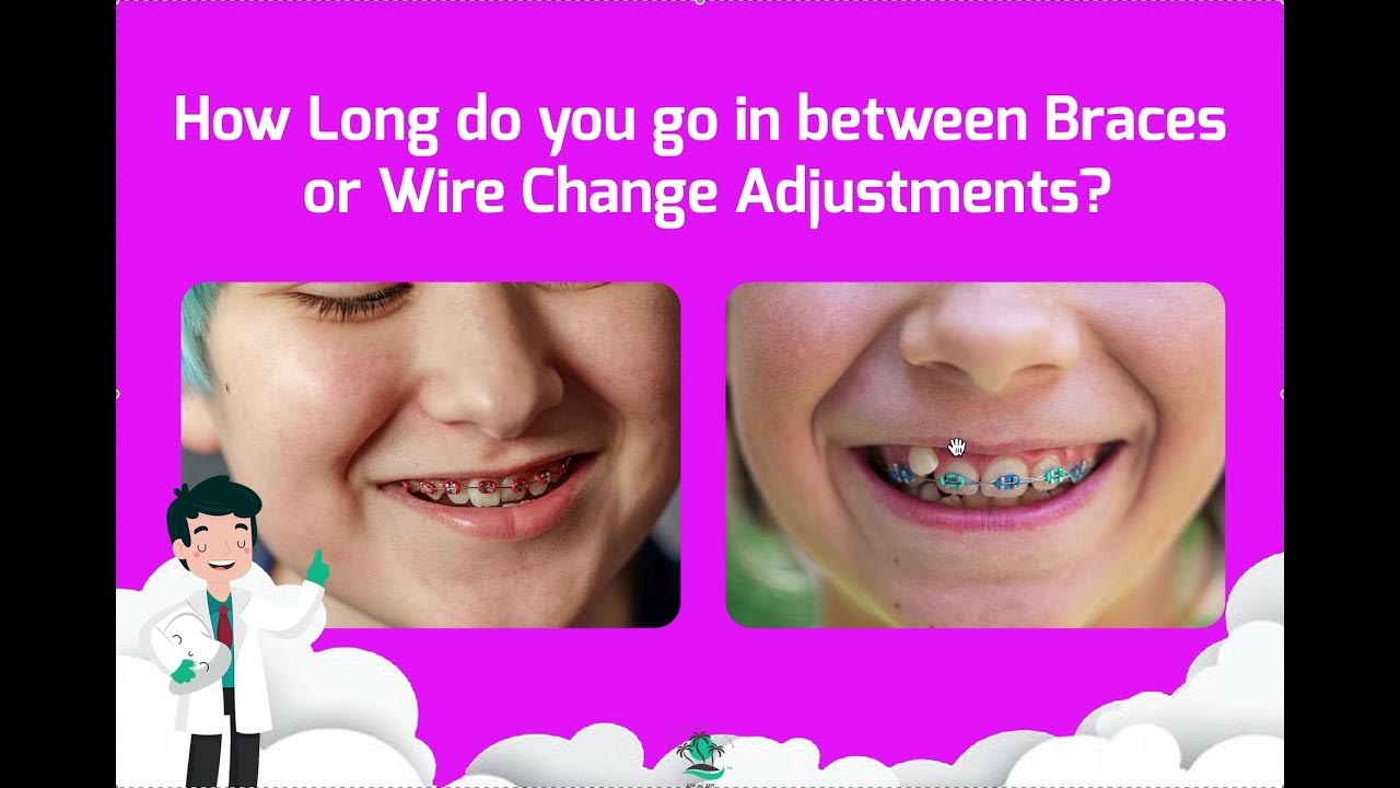 Wire Change Frequency Straightwire Appointment Sequence Braces
