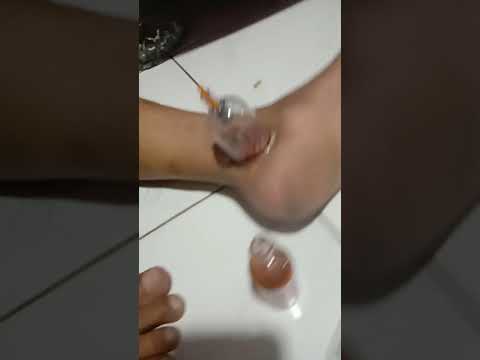 Apa Gejala dan Penyebab Penyakit Asam Urat? Bagaimana Cara Mengobatinya?. 
