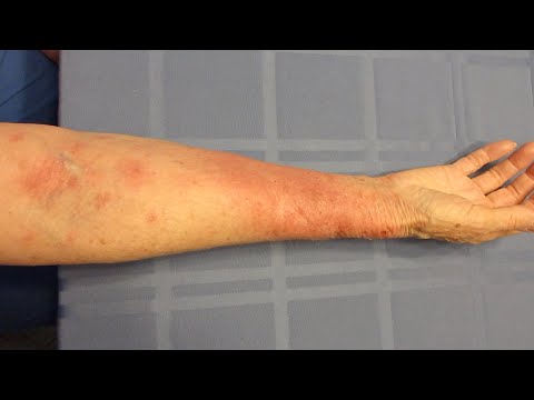 Video: Poison Oak Rash: Bilder Und Heilmittel