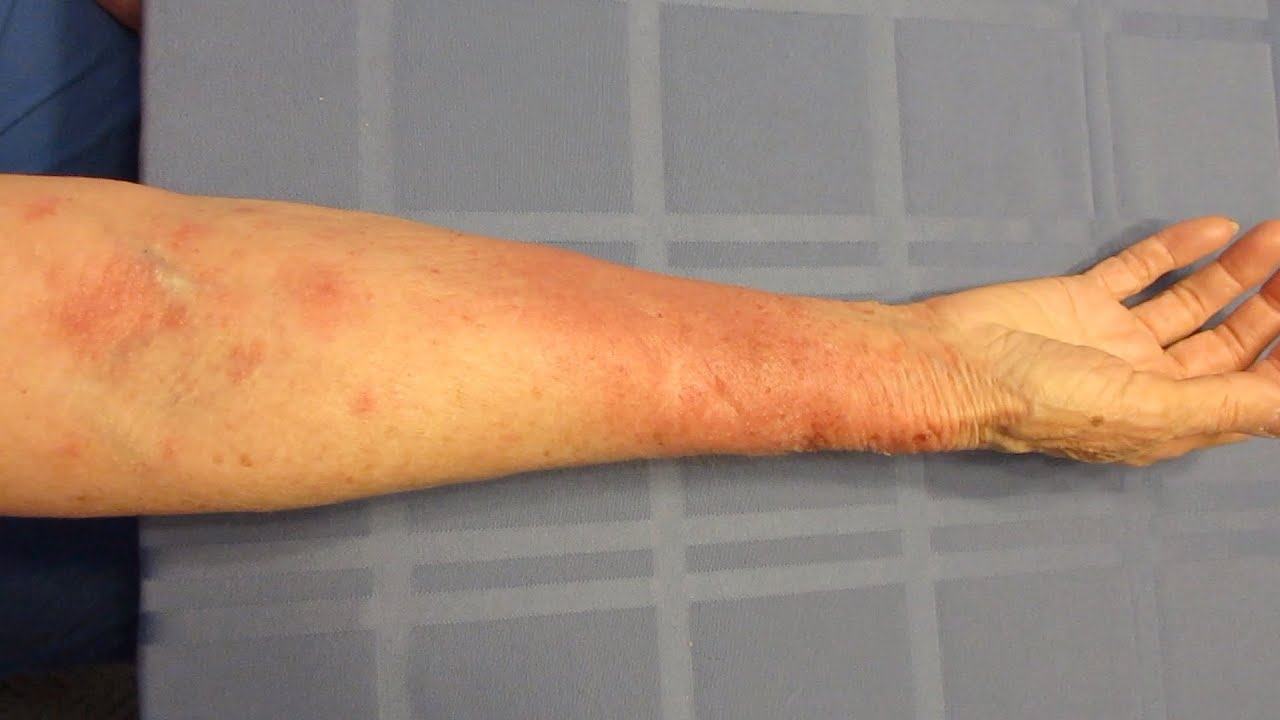 Poison Ivy Rash Poison Oak Poison Sumac YouTube