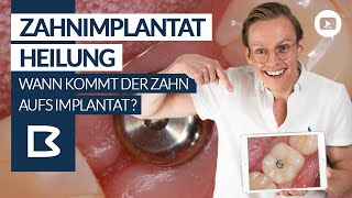 ZAHNimplantat - Heilung? Wann kommt der ZAHN auf das Implantat? Genaue Zeitangaben!