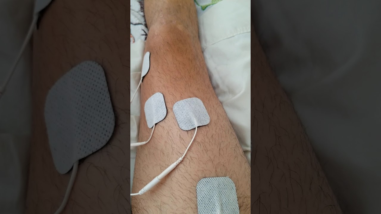 ACL surgery day 25 quad YouTube