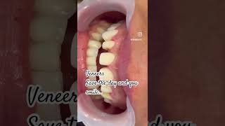 #smilemakeover #smilecare #dentalcare #celebritydentist #dentalveneers #teeth #teethinaday #dental